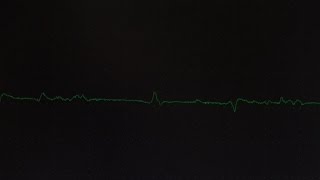 EMG Fibrillations and Fasciculations [upl. by Alage]