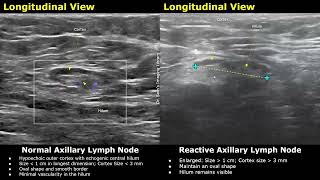 Axillary Lymph Nodes Ultrasound Normal Vs Abnormal Images With Doppler  Reactive amp Malignant Nodes [upl. by Sagerman]