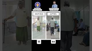 Hip Replacement BEFORE amp AFTER viralvideo shorts trending youtubeshorts pain surgeryday [upl. by Elboa682]