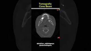 Cone beam conebeam cbct tomografiacomputadorizada hazconico radiologiaodontologica odonto [upl. by Ycniuqed]