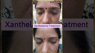 Xanthelasma removal treatment  Xanthelasma treatment laser  youtubeshort shorts xanthelasma [upl. by Eirolam]