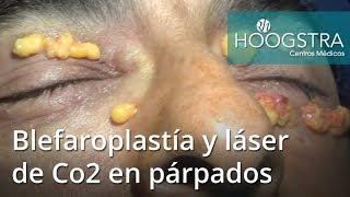 Blefaroplastía y láser de Co2 en párpados 18010 [upl. by Fromma]