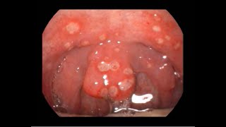 Acute Ulcerative Pharyngitis Causing Severe Sorethroat [upl. by Ystap]