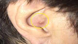 how to get rid of a boil in your ear WITHOUT PRODUCTS [upl. by Inohs]