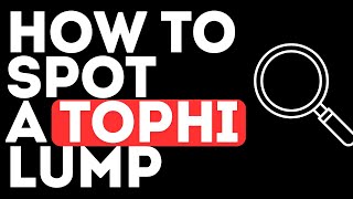 How to Spot a Tophi Lump in Your Body  Gouty Tophi  Gout  Self Examination [upl. by Aretha]