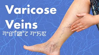 Varicose Veins ꯚꯦꯔꯤꯀꯣꯖ ꯚꯦꯏꯟ [upl. by Melac]