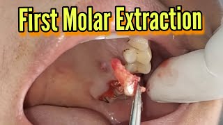 First molar extraction 26 [upl. by Igic89]