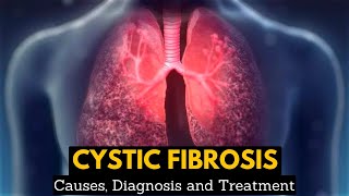 CYSTIC FIBROSIS Causes Signs and Symptoms Diagnosis and Treatment [upl. by Claudelle]