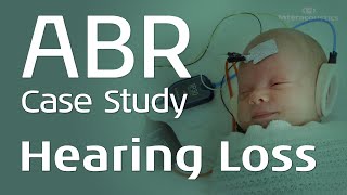 ABR Case Study Sensorineural Hearing Loss [upl. by Earised]