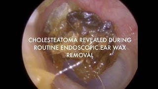 Cholesteatoma Revealed During Routine Endoscopic Wax Removal  Ep 07 [upl. by Munmro]