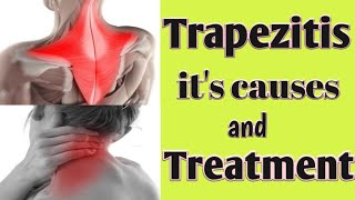 Trapezitis  its causes and Treatment [upl. by Hartzel]