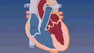 Tetralogy of Fallot [upl. by Baruch]