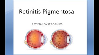 Ophthalmology 297 Retinitis Pigmentosa Dystrophy night blind dominant bone corpuscle ERG vitamin A [upl. by Holsworth104]