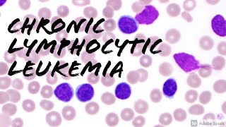 Chronic Lymphocytic Leukemia CLL Peripheral Blood Smear Hemepath Hematology Pathology [upl. by Sewoll]