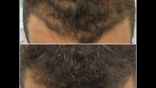 Combining Micro Scalp Pigmentation with Long Hair  Vinci Hair Clinic [upl. by Nahem]