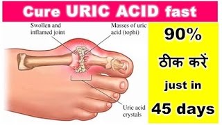 URIC ACID 90 ठीक करें just in 45 days  Cure URIC ACID fast Relieve your Body Pain Dr Shalini [upl. by Francoise197]