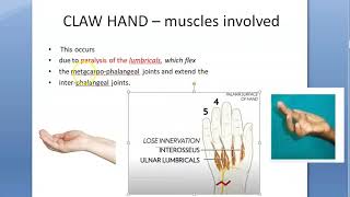 Orthopedics 083 claw hand ulnar nerve palsy type treatment ape simian lumbrical paradoxical Zancolli [upl. by Aihsei115]