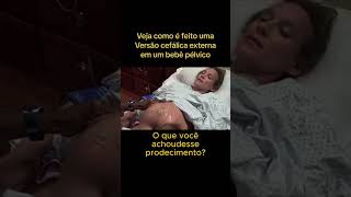 Versão cefálica de bebê pélvico gestacao maternidade partohumanizado [upl. by Abekam]