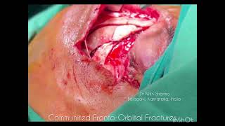 Frontal Bone Orbital Roof Fracture [upl. by Anayia]