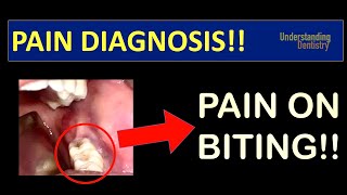 Pain on Biting How to know the cause Tooth pain cbct in dentistry lecture x ray interpretation [upl. by Curcio]