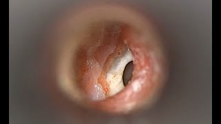 Otomycosis Ear Dusting with Antifungal Powder [upl. by Ayerf]