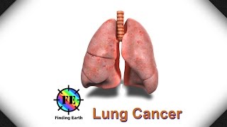 Lung Cancer  Symptom Causes amp Diagnosis Finding Earth [upl. by Perice104]