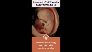 Early Fetal Echocardiography for fetuses with increased NT by Dr Fred Ushakov [upl. by Cut]