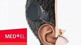 The RONDO cochlear implant from MEDEL  2D  INT [upl. by Parker424]