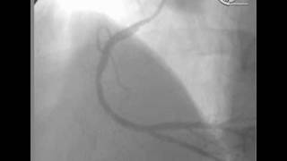 angioplastia en Infarto Agudo [upl. by Fauver]