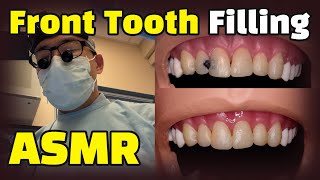 How to fix cavities between front teeth  Dental ASMR Composite Resin Filling Procedure Explained [upl. by Ahsilif]