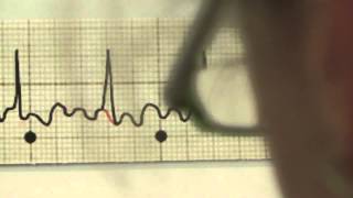 EKG für Pflege Teil 20  Vorhofflattern interpretieren [upl. by Tilly]