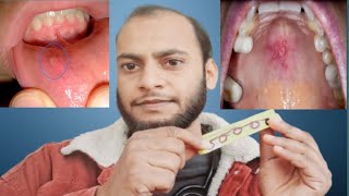 Mouth infection best treatment in hindi [upl. by Notserk]