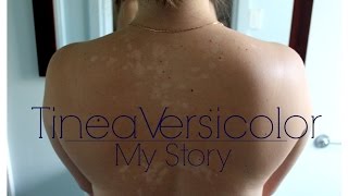 Tinea Versicolor Part 1  TNBeauty94 [upl. by Adaminah903]