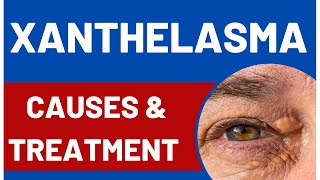 Xanthelasma Meaning Causes And Treatment [upl. by Coleen]