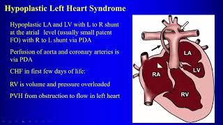 19 Congenital heart disease causing pulmonary venous hypertension and CHD with normal vascularity [upl. by Aleunam11]