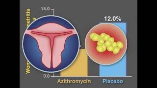 PostCesarean Infection and Antibiotic Prophylaxis  NEJM [upl. by Karlens]