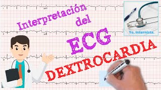 ECG Dextrocardia su análisis [upl. by Orlando]