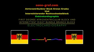 Elektrokardiographie  Atrioventrikulärer Block Ersten Grades Intermittierender Rechtsschenkelblock [upl. by Lexie]