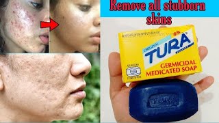 TURA Germicidal Medicated Soap Review  Get Rid Of Stubborn ACNE amp BLACKSPOTS [upl. by Adnerad431]