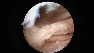 Posterior Ankle Arthroscopy Os Trigonum SFISM [upl. by Enilamme99]