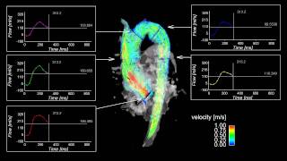 Aortic 4D flow MRI  3D blood flow visualization amp flow quantification in aortic valve insufficiency [upl. by Pascia]