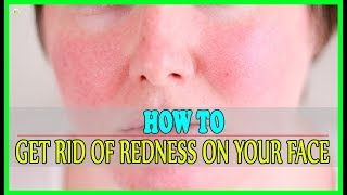 How To Get Rid Of Redness On Your Face  Best Home Remedies [upl. by Noraha]