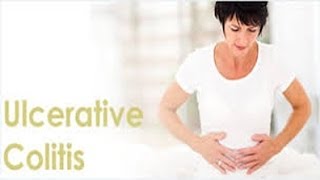 Ulcerative Colitis Permanent Cure [upl. by Kusin]