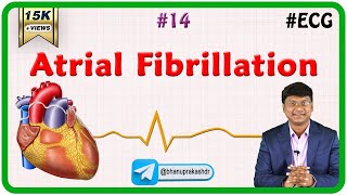 14 Atrial fibrillation  ECG assessment and ECG interpretation made easy [upl. by Sinclare252]