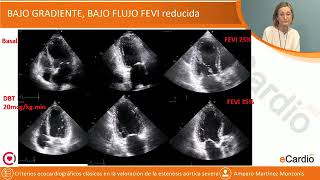 Estenosis aórtica severa ecocardiograma en toma de desiciones [upl. by Llywellyn69]