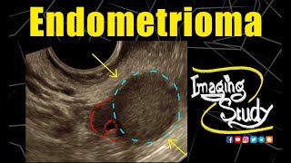 Endometrioma  Chocolate Cyst  TVS  Ultrasound  Case 263 [upl. by Adnih760]