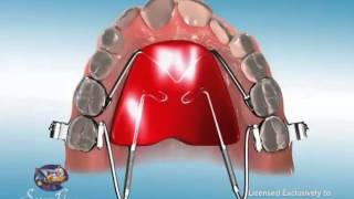 ES Ortho and Distal Jet Appliance [upl. by Ainehs]