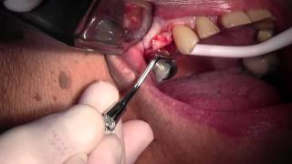 CAMLOG Implant Placement 5 Site Flap Design amp Pilot Hole [upl. by Bevus]