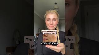 The best treatment for atrophic acne scars acnescars acne skinadvice skincaretips skincare [upl. by Goodspeed]