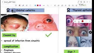 Orbital Diseases Ptosis OPH [upl. by Timothee]